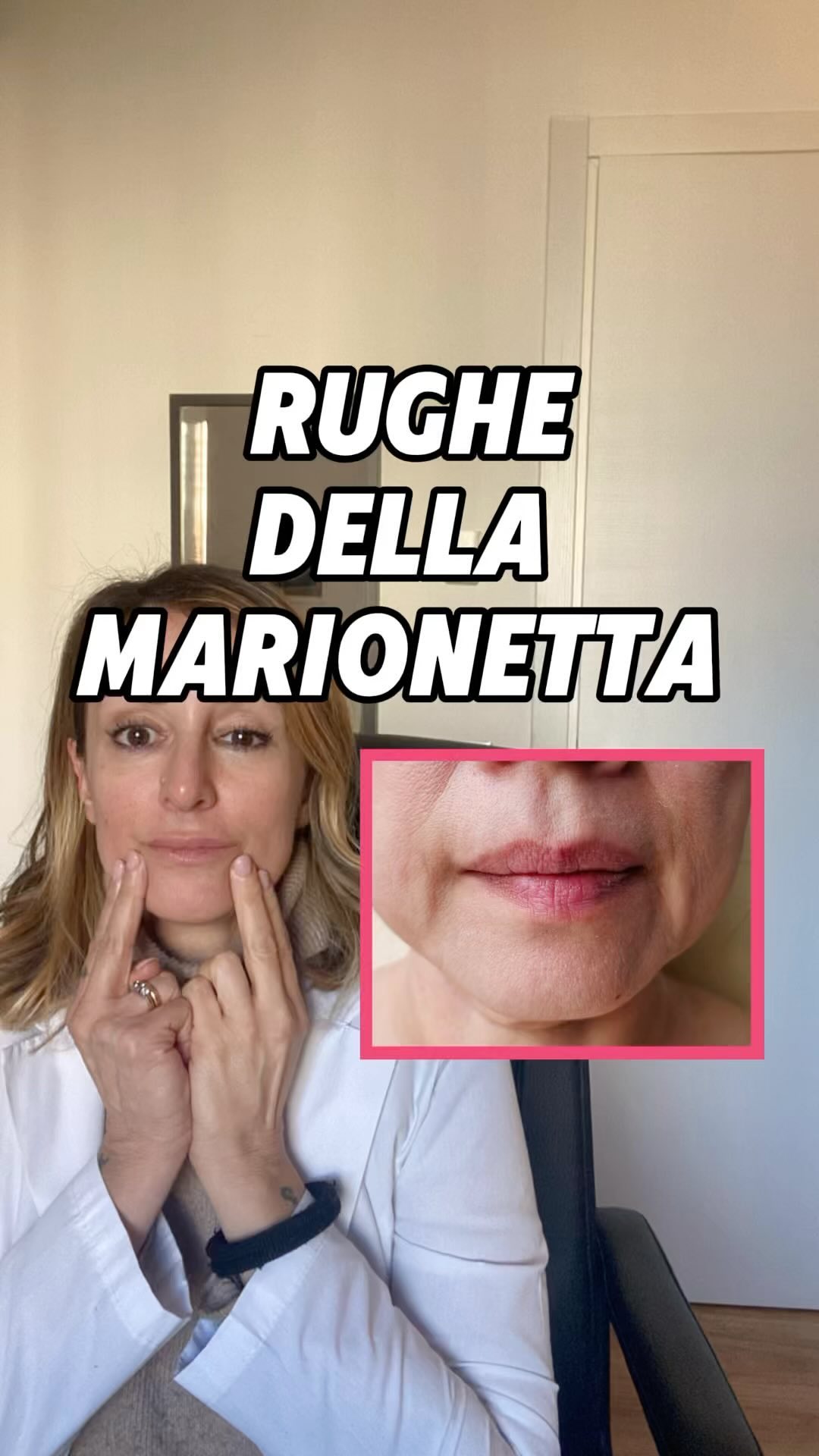 ‼️RUGHE DELLA MARIONETTA 👇🏻
.
👉🏻Le rughe della marionetta sono quelle linee verticali che si for